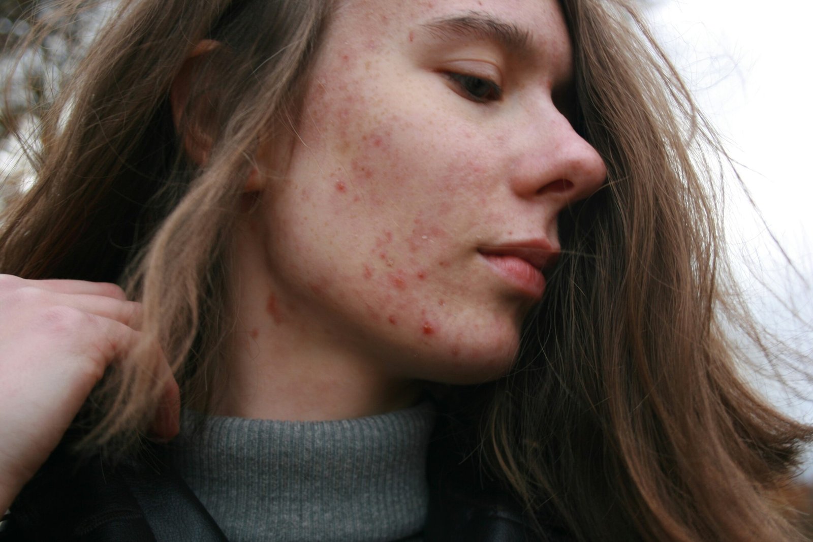 Woman with acne scars