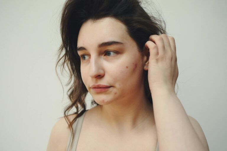 A woman with acne